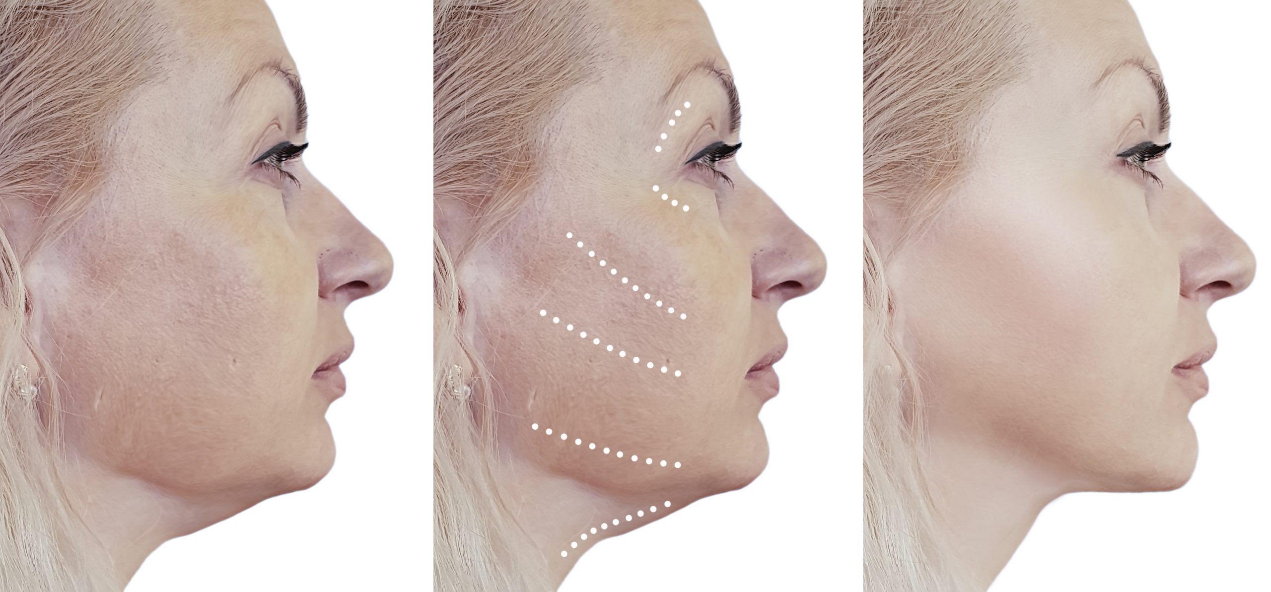 Tratamiento Flacidez rostro con hilos tensores. Indoloro, sin hematomas